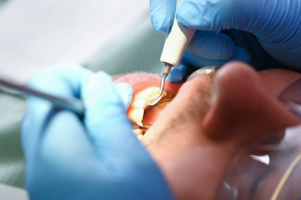 Best Emergency Dental Care for Abscessed Tooth in Lake Catherine, IL